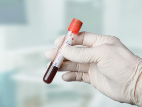 Tiroler Studie mit möglichem Therapieansatz bei Blutkrebs