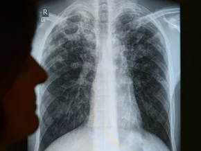 Neue Tuberkulose-Impfstoffe sollen Millionen Leben retten