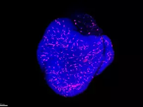 Multidisziplinäre Behandlung der Karotis-Pathologie