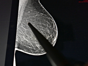 Brustkrebs: Früherkennung rettet Leben