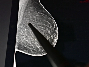 Rund 409.000 Menschen hatten Anfang 2025 in Österreich Krebs