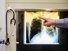 Tuberkulose in Österreich stabil auf niedrigem Niveau