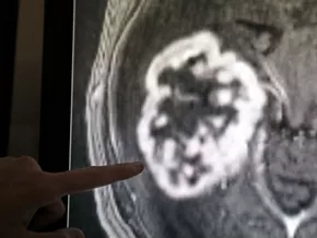 WHO fürchtet Verdoppelung der Krebsdiagnosen