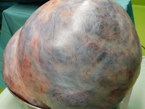 Patientin in der Steiermark mit 18 Kilogramm schweren Tumor
