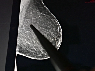 Rund 409.000 Menschen hatten Anfang 2025 in Österreich Krebs