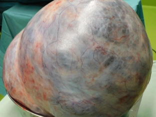 Patientin in der Steiermark mit 18 Kilogramm schweren Tumor