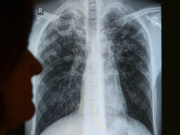 Neue Tuberkulose-Impfstoffe sollen Millionen Leben retten