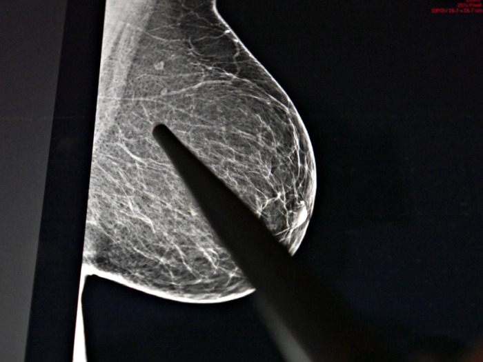 Rund 409.000 Menschen hatten Anfang 2025 in Österreich Krebs