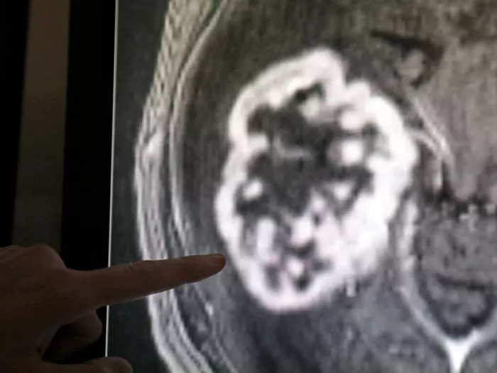 WHO fürchtet Verdoppelung der Krebsdiagnosen
