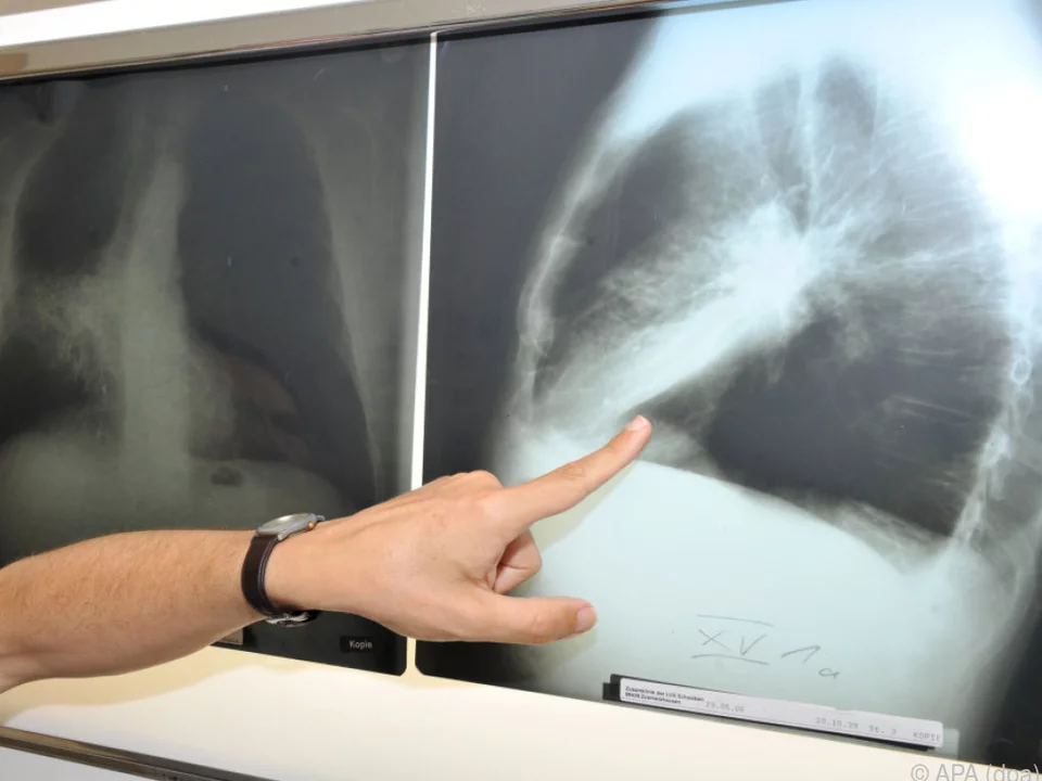 Am Sonntag wird der Welt-Krebstag begangen