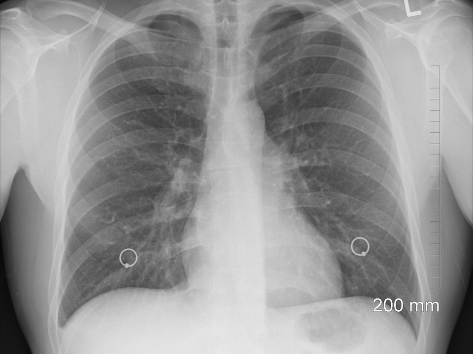 Lunge Röntgen