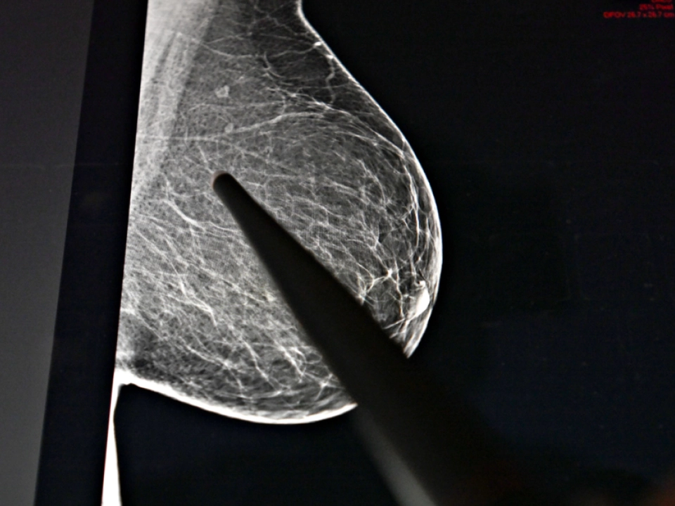 Häufigste Diagnose bei Frauen war Brustkrebs