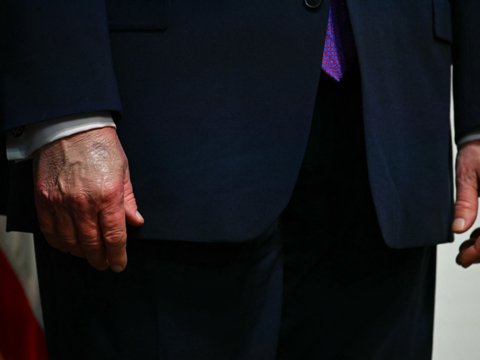 Die Hände Trumps sorgten für Fragen über dessen Gesundheitszustand